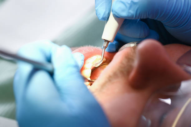 Best Emergency Dentist for Lost Fillings or Crowns in State Line, PA